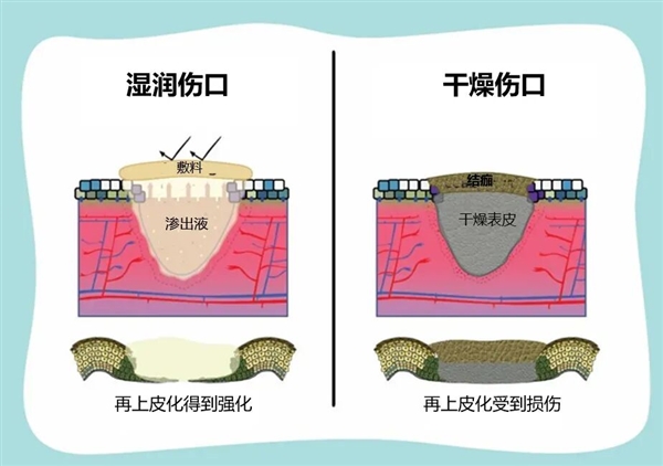 伤口“晾干”好 还是“保湿”好？很多人都不知道