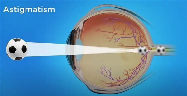 总是模糊重影 看灯会散开：你的眼睛可能出现这问题了