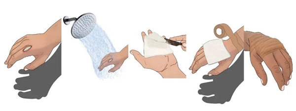 伤口“晾干”好 还是“保湿”好？很多人都不知道