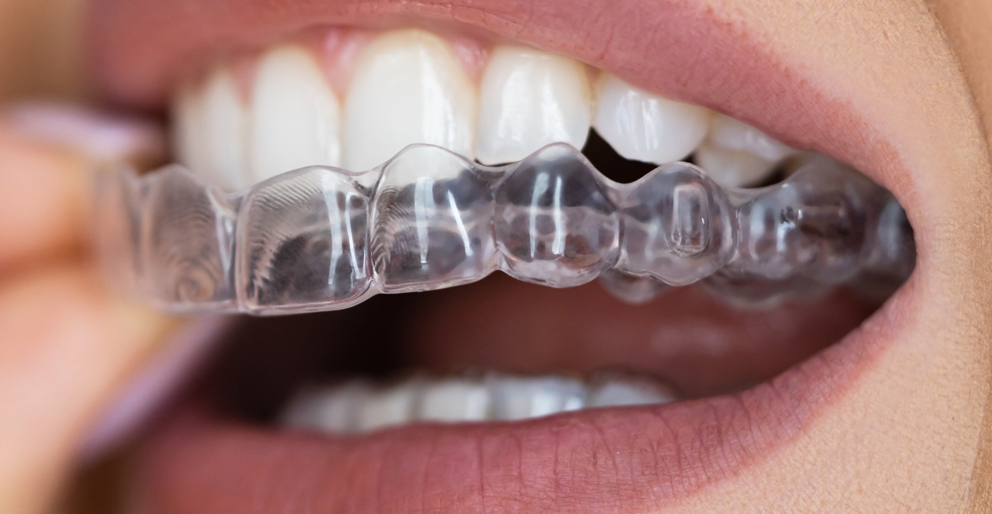Study: The Changes of Microbiome Attached on Clear Aligners after Drinking Coca-Cola. Image Credit: Andrey_Popov / Shutterstock