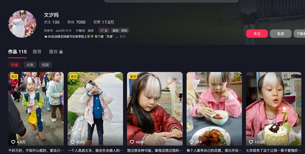 7岁女孩天生白色刘海：确认罕见病