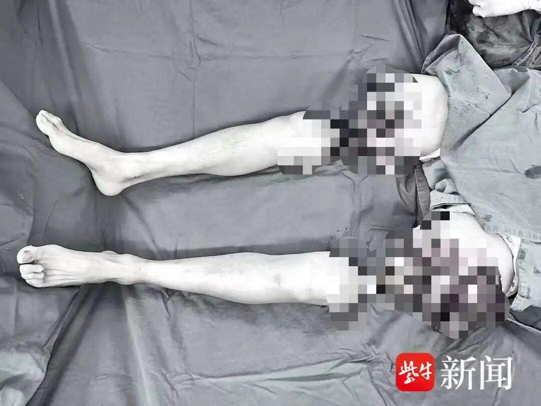 接诊时江先生双大腿已完全离断。